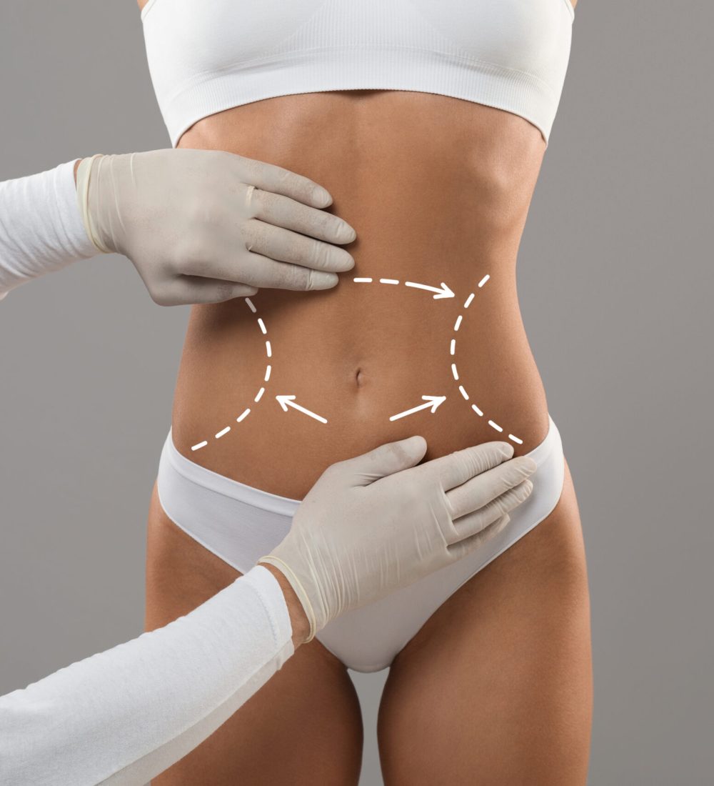 Body Contouring Concept. Unrecognizable Doctor Wearing Gloves Touching Female Body With Marked Lines In Abdomen Zone, Woman Patient Preparing For Liposuction Plastic Surgery, Cropped Shot