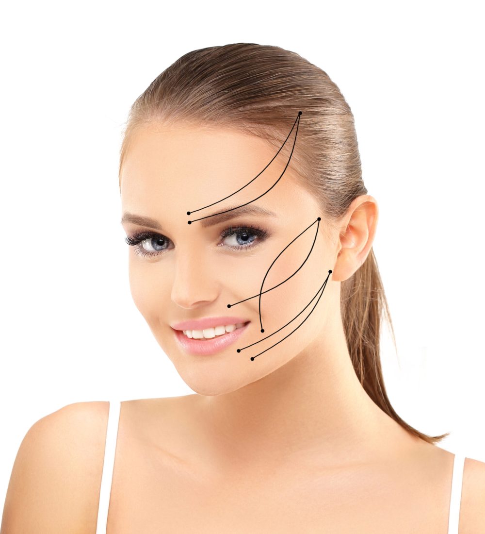 thread lift , nonsurgical procedure,lower facelift